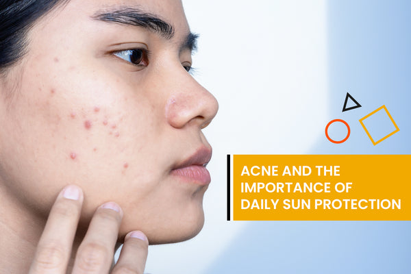 Acne and the importance of daily sun protection